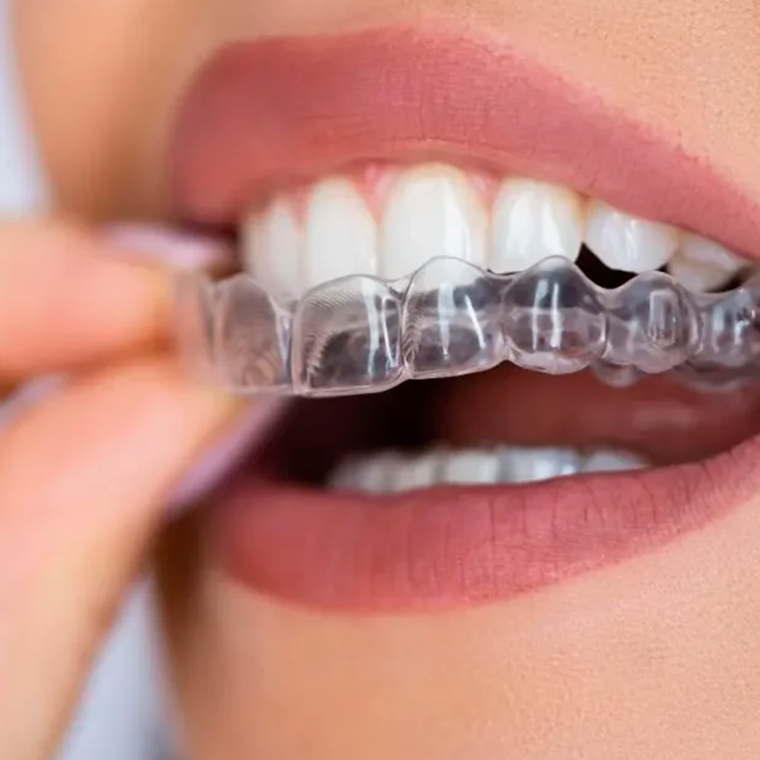 Alinhador invisível transparente sendo colocado nos dentes
