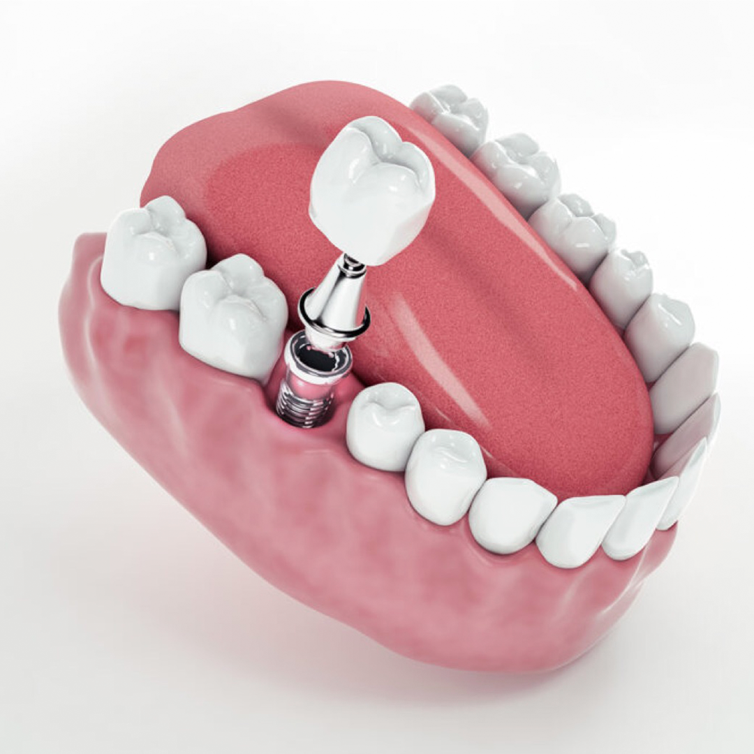 Ilustração de um implante dentário com a coroa sendo encaixada